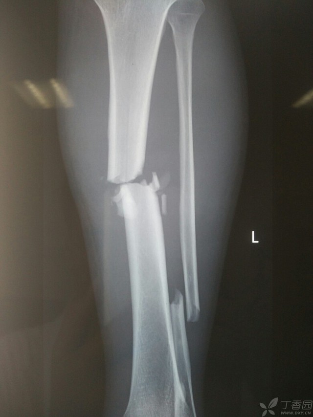 科技重塑脛腓骨骨折康復(fù)之旅，引領(lǐng)未來體驗(yàn)新篇章