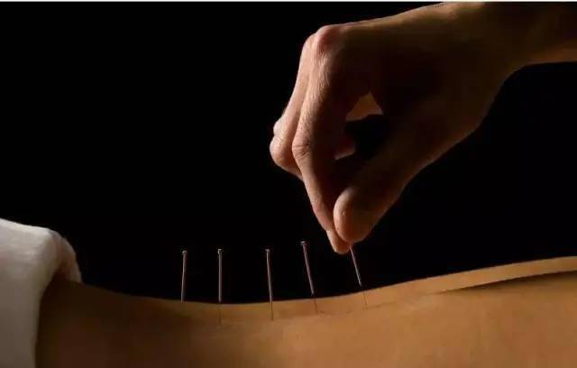 平衡針灸最新視頻，現(xiàn)代應(yīng)用探索針灸藝術(shù)的新境界