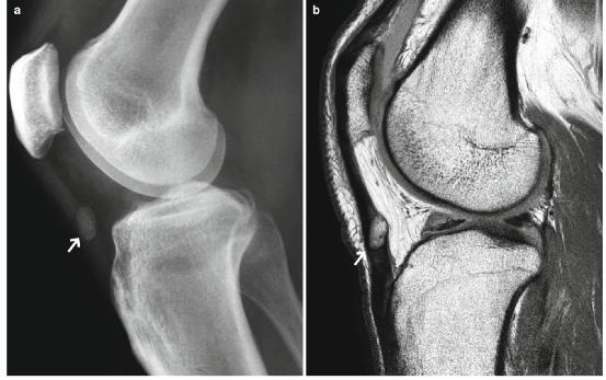 髕腱炎成為醫(yī)學焦點，從幕后走向舞臺中央的最新進展