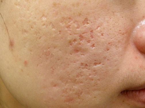 最新痘坑撫平神器，科技重塑肌膚之美，自信生活從此開(kāi)始