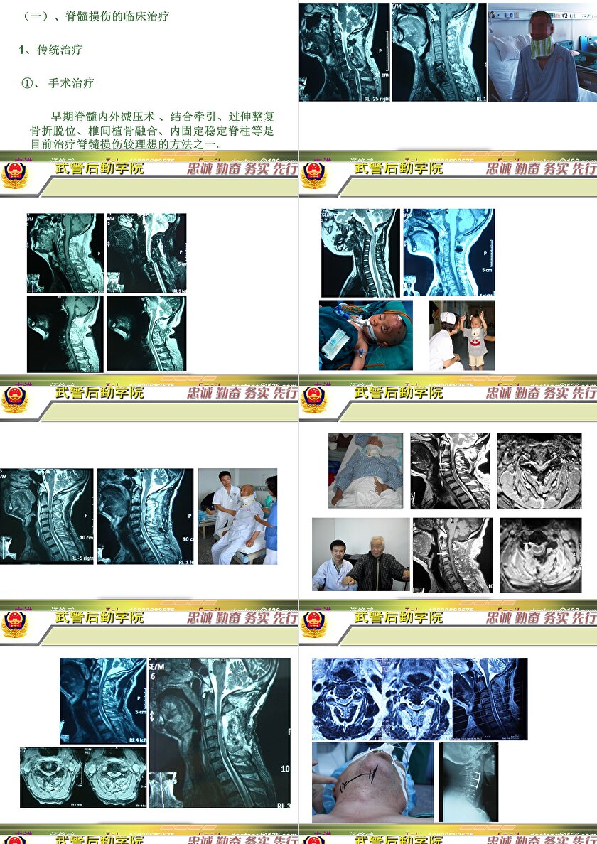 2023年脊髓損傷研究新進(jìn)展，里程碑式的突破與日常奇妙變化