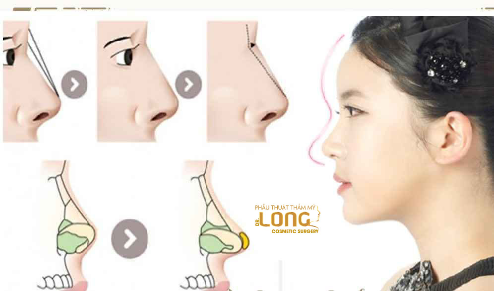 最新鼻整形技術(shù)重塑自信，煥發(fā)新生之美