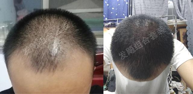 治愈脫發(fā)最新重大突破，重塑自信，希望之光再現(xiàn)