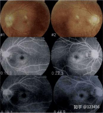 最新藥肺炎詳解，你需要知道的一切——健康小紅書(shū)